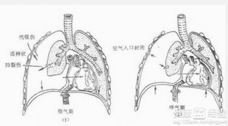 揭秘气胸，一种你可能不了解的病症，症状与防治全解析！内含惊人真相等你揭晓。